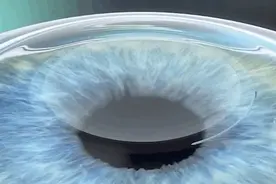 激光近视矫正手术安全吗？它的具体操作原理是什么？图片