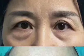 从整形医生的角度聊一聊关于提眉手术常见的6个主要问题图片
