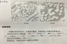 超一半患者被误诊漏诊！警惕善于“伪装”的多发性骨髓瘤｜“323”直播预告图片
