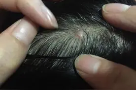 头发里硬硬的小脓包，千万不要乱挤，这样处理更安全图片