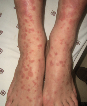 脚上起来好多小红点