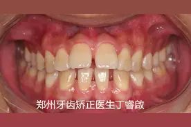郑州牙齿矫正丨27副牙套，在悄悄变美图片