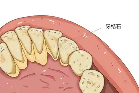 牙齿布满黄黄的泥，还臭烘烘的，是什么原因？医生明确告诉你图片