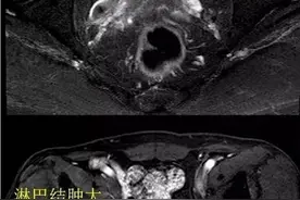 为什么越来越多年轻人患上前列腺癌？图片