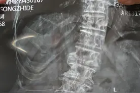 腰痛发展到脊柱侧弯，医生嘱咐少干重活，不是随便说说图片