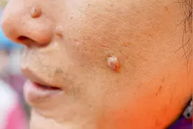 身上有痣的看看：若出现这5个变化，可能发生癌变了，尽早处理图片