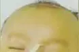 1例母乳性黄疸的治疗过程图片