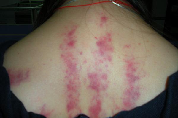 经常刮痧的人,身上刮出来的"痧"是什么?红印越多越有效?