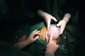 妈妈生下“果冻宝宝”，爸爸吓坏了，医生：这种情况十分罕见图片