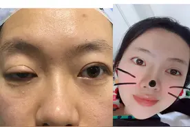 上睑下垂矫正实例：上帝为您关上了门，同样为您打开一扇窗图片