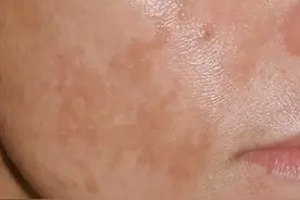 黄褐斑不能治疗？皮肤科医生：当然能治，这3个方法告诉你了图片