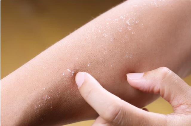 新生儿湿疹可以擦身体乳吗