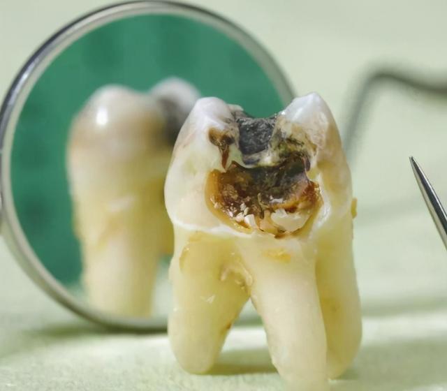 因为杀了神经的牙齿,没有了牙髓提供营养,会变得脆弱.