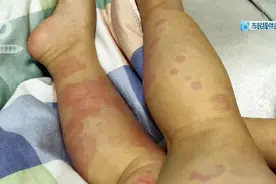 海洋球真的有危险！看看这个1岁宝宝满身的红疹，你还想玩吗？图片