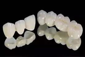 烤瓷牙桥修复的好处，跟种植牙比区别在哪？一起来看看牙医怎么说图片