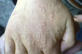 当小孩手上出现密集小丘疹，可能和这些玩具有关图片