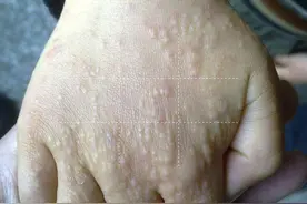 当小孩手上出现密集小丘疹，可能和这些玩具有关图片