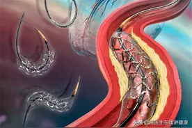 心脏支架后能活几年？医生实话实说：支撑生命的是这4个关键点图片