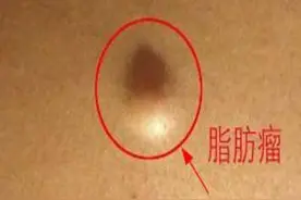 不知不觉长了个脂肪瘤，它是怎么形成的，对身体健康有影响吗图片