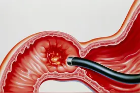 为什么会产生十二指肠溃疡？它症状有哪些？治疗时应该注意什么？图片