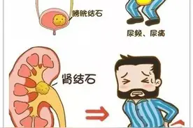 肾结石的病因病机和中药治疗方案图片