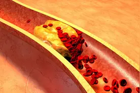 血管堵塞，脚先知！脚上有4个表现，请及时去检查，以免血栓堆积图片