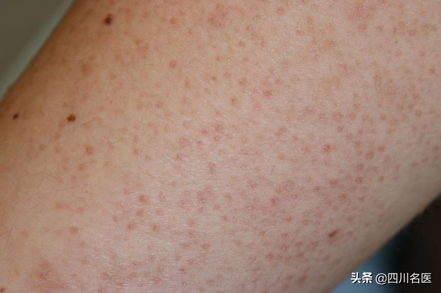 治鸡皮肤最好的医生