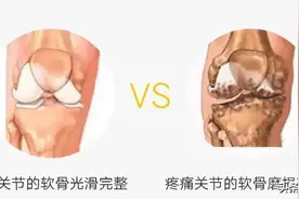 老年人膝关节疼痛、变形不想换关节怎么办？PRP“一针”帮您解决图片