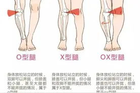 腿型矫正系列——每天10分钟，这个动作可以帮你轻松矫正XO型腿图片