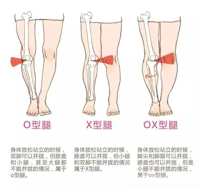 改善xo型腿最有效的动作（腿型矫正系列每天10分钟）