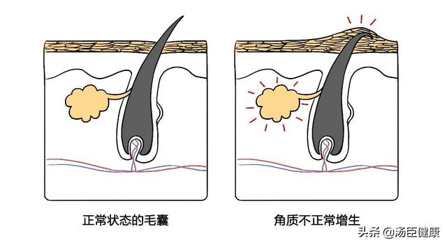 结婚时手臂鸡皮肤