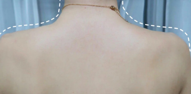 女生身上鸡皮肤好吗