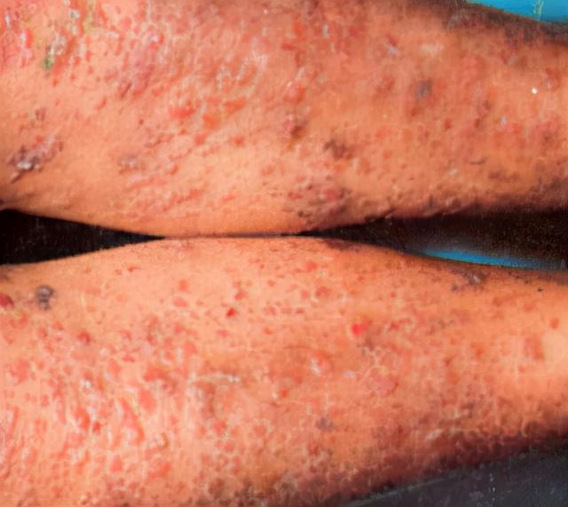 屁股上的小疙瘩是毛周角化吗