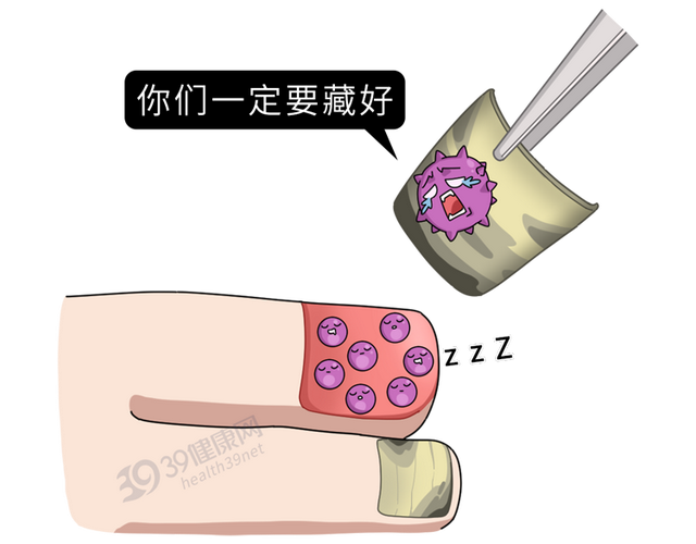 得了灰指甲，反复发作难根治？一次性介绍7种药，总有一款适合你