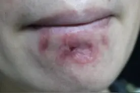 由“上火”发现的梅毒图片