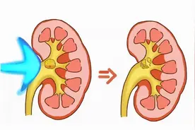 打过一次肾结石，还能再打吗？今天就讲讲关于碎石的那点事图片