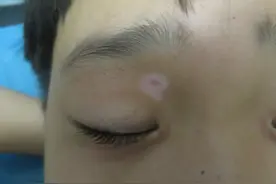 村里人说这个痣非“凶”即“淫”，吓得妈妈赶紧带孩子去点痣图片