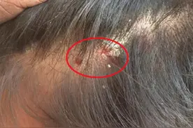 头皮总是长“疙瘩”和“脓包”，是咋回事？或是这3方面的原因图片
