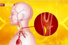 打喷嚏时，最怕你做“这件事”，当心血管破裂！3类人尤其危险，别等脑梗了才后悔图片