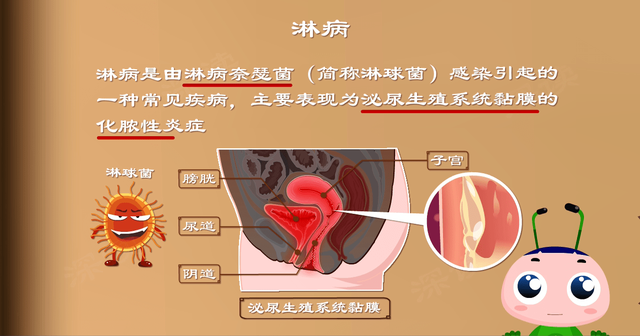 淋病能治愈吗？（全球每年约20万妇女得淋病淋病知识解读）