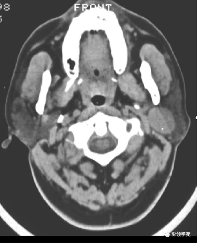 腮腺角化型鳞癌