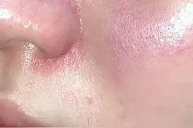 有哪些适合敏感肌混油痘皮的护肤产品推荐？图片