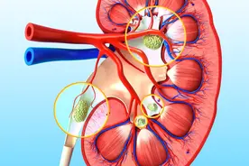 肾结石▍半夜肚子剧痛，起床后发现尿液中惊现石头，石头是什么呢图片