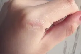 液体创可贴好用吗？图片