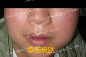 为什么我的皮肤变得这么敏感？图片