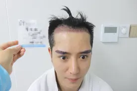 这些生活习惯让发际线越来越高！牢记这几点，护住你的发际线图片