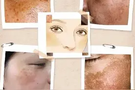 黄褐斑，该拿什么拯救你？图片