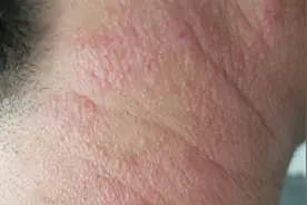 痒痒痒，痒了抓，抓了还痒，多是神经性皮炎在作祟图片