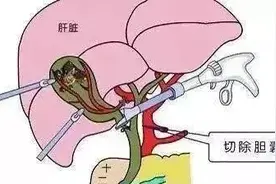 吕梁市中医院手术室-腹腔镜胆囊切除术的术后恢复须知图片