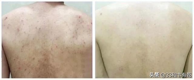 火爆INS的芝士皂，洗脸就像敷面膜，痘痘，黑头，螨虫全都消失了